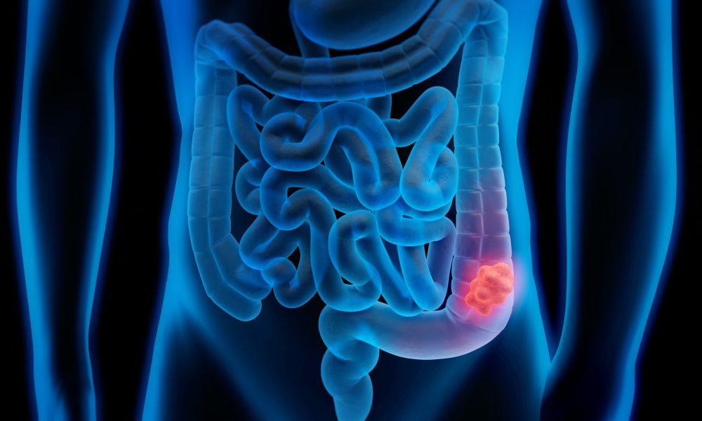 Colorectal Cancer