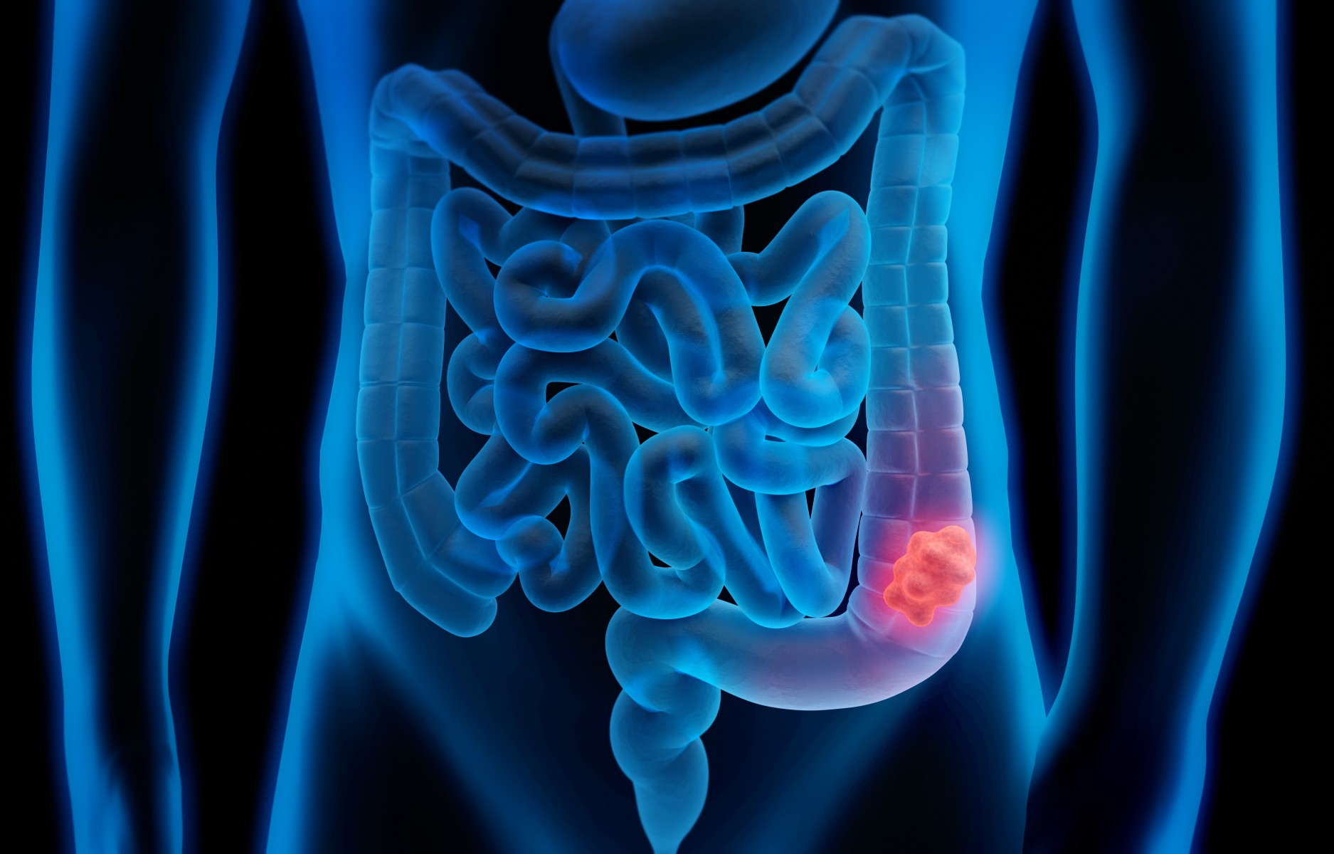 Colorectal Cancer