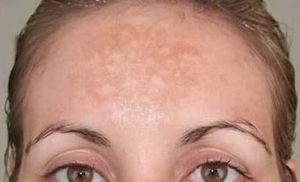 melasma