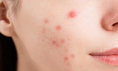 Acne Issue