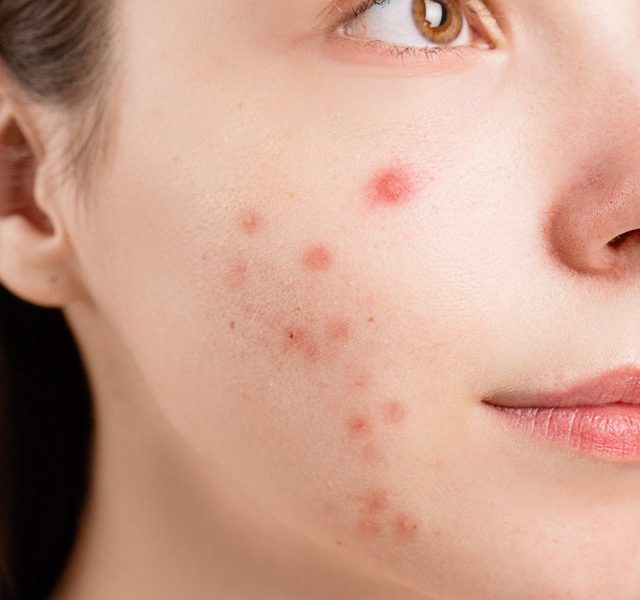 Acne Issue