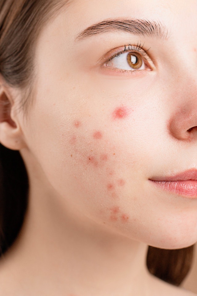 Acne Issue