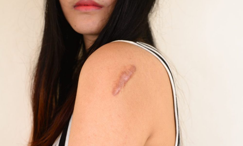 Keloid Scars