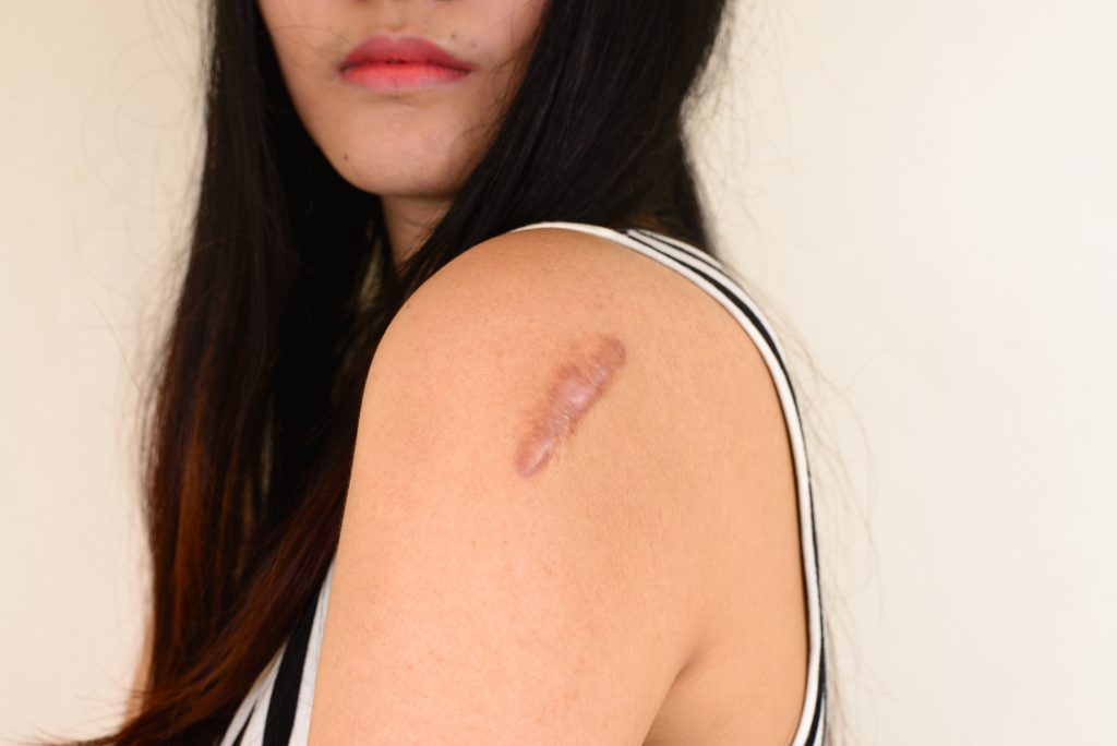 Keloid Scars