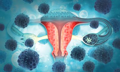 Signs of Ovarian Cancer