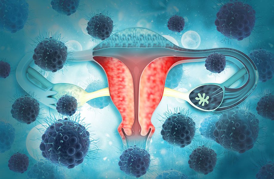 Signs of Ovarian Cancer