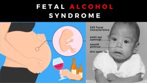 Fetal Alcohol Syndrome