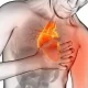 Types of Angina