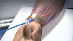 Ventricular Septal Defect 