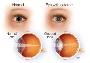 Diabetes and Eye Health