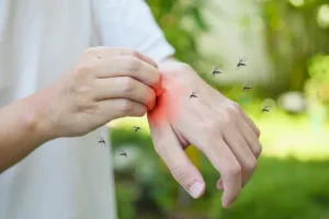 Insect Stings