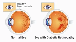 Diabetes and Eye Health