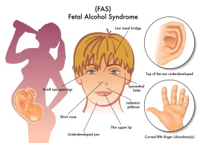 Fetal Alcohol Syndrome