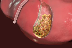 Gallstones