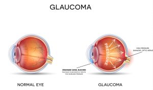 Diabetes and Eye Health