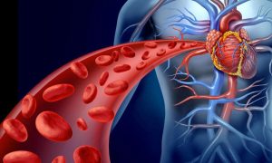 Ventricular Septal Defect 