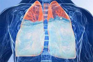  Lung Diseases