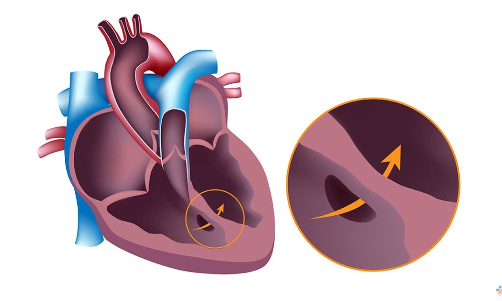 Ventricular Septal Defect