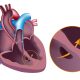 Ventricular Septal Defect