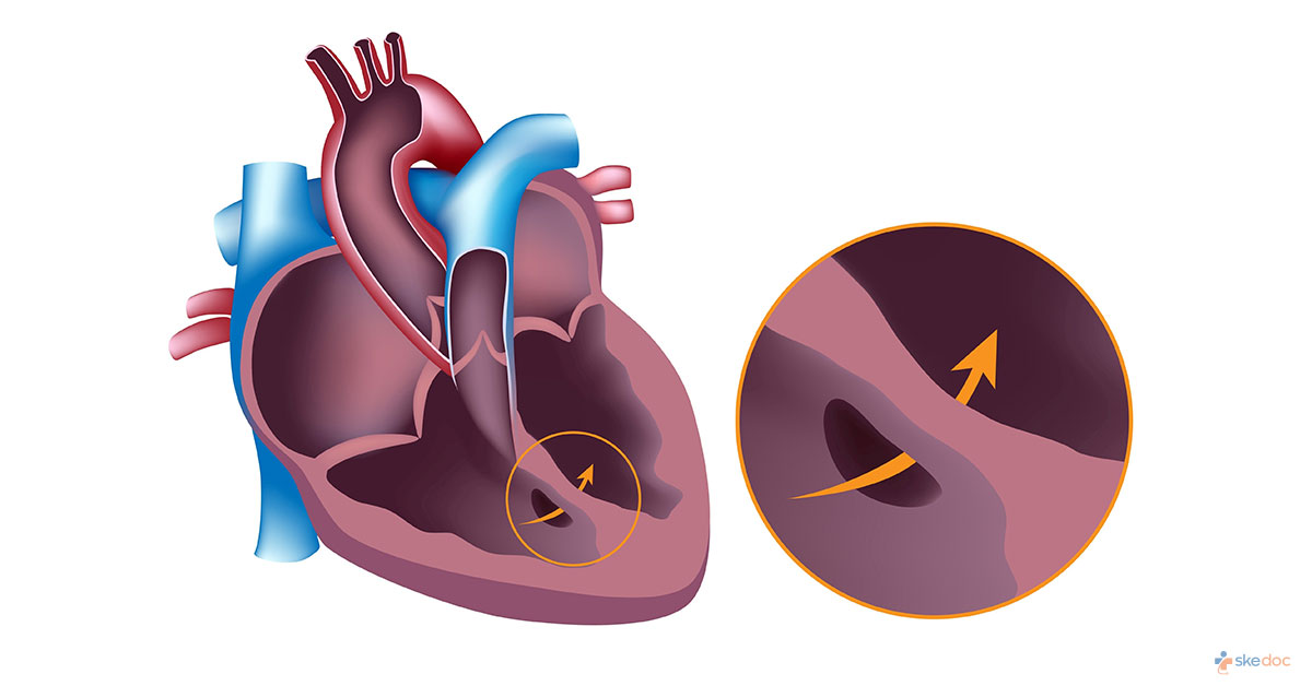 Ventricular Septal Defect