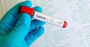 Typhoid Fever