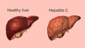 Hepatitis C Disease