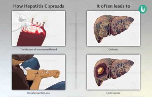 Hepatitis C Disease