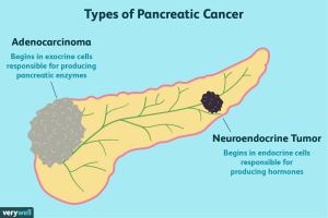 Types of Pancreatic Cancer