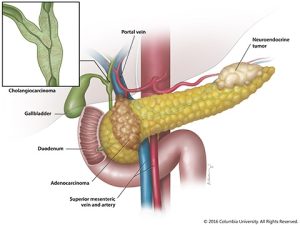 Pancreatic Cancer