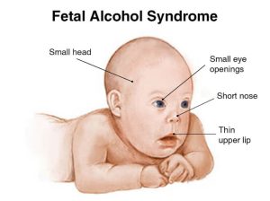 Fetal Alcohol Syndrome