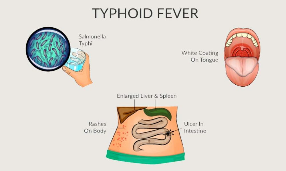 Typhoid Fever