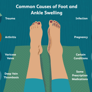 Ankle Swelling