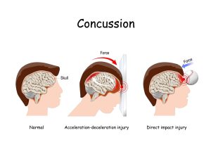 Concussion Symptoms