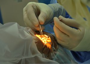 Cataract Surgery