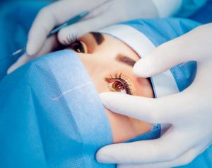 Cataract Surgery