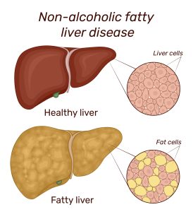 Risks of Fatty Liver