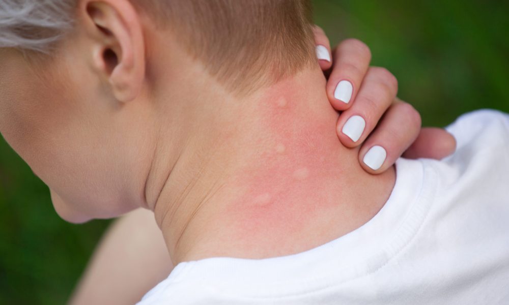 Heat Rash Awareness