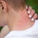 Heat Rash Awareness