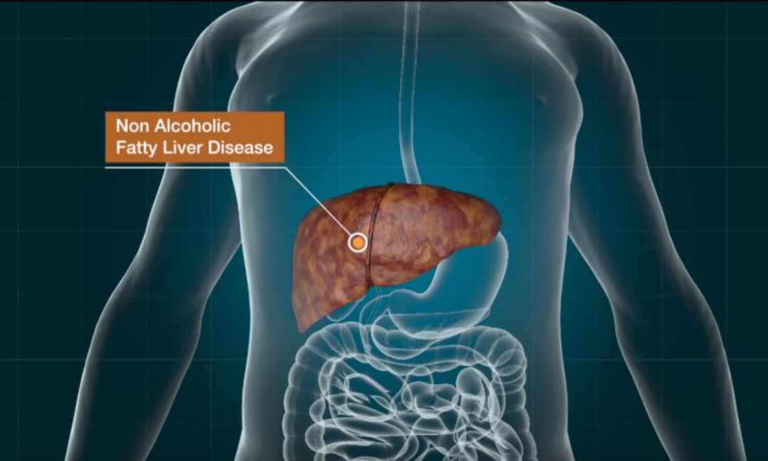 Risks of Fatty Liver