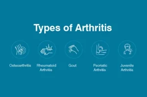 Running-Arthritis