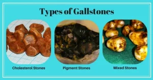 Gallstone Formation