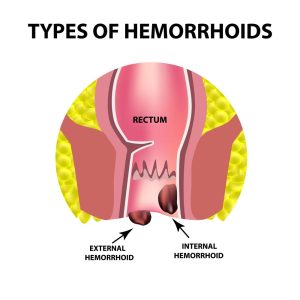 Hemorrhoid Discomfort