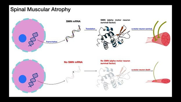 Spinal Muscular Atrophy and Liver Damage: Latest Study