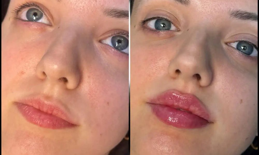 fillers in dubai