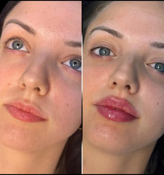 fillers in dubai