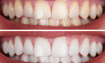 The Ultimate Guide to Teeth Whitening: Brighten Your Smile Naturally and Safely