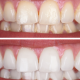 The Ultimate Guide to Teeth Whitening: Brighten Your Smile Naturally and Safely
