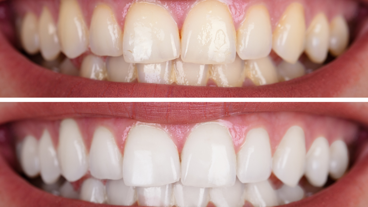 The Ultimate Guide to Teeth Whitening: Brighten Your Smile Naturally and Safely