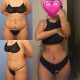 Tummy Tuck in dubai
