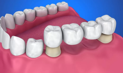 Why I Recommend Tooth Implants Over Bridges as a Dentist